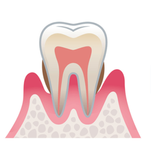 歯周病中等度